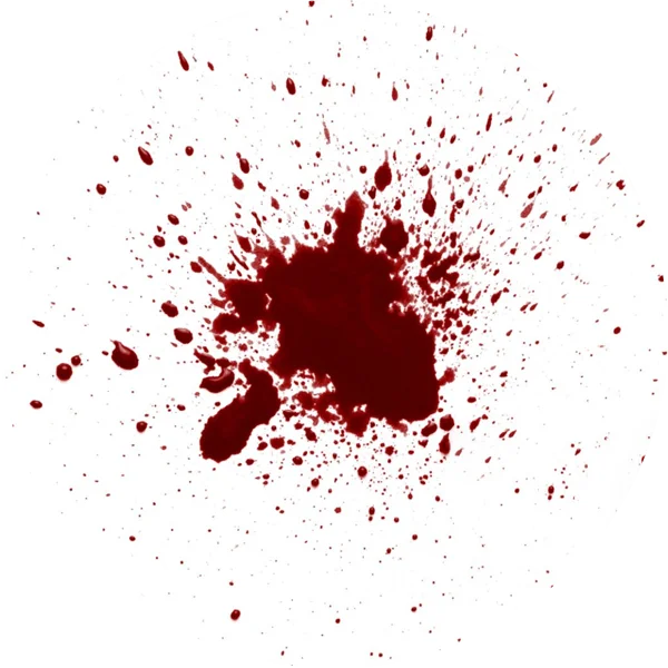 Image showing fluid or pus discharge associated with anal fistula.