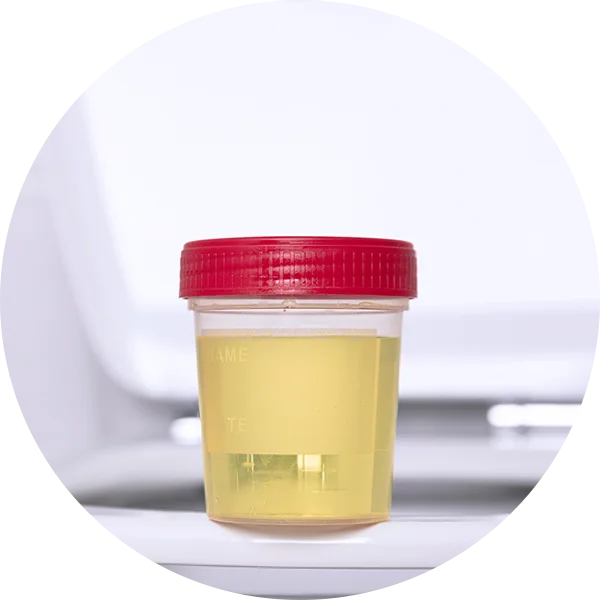 Urine sample container showing sugar-containing urine, a sign of uncontrolled diabetes.