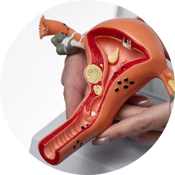 Model holding an anatomical uterus model to represent painful menstrual cramps or endometriosis.